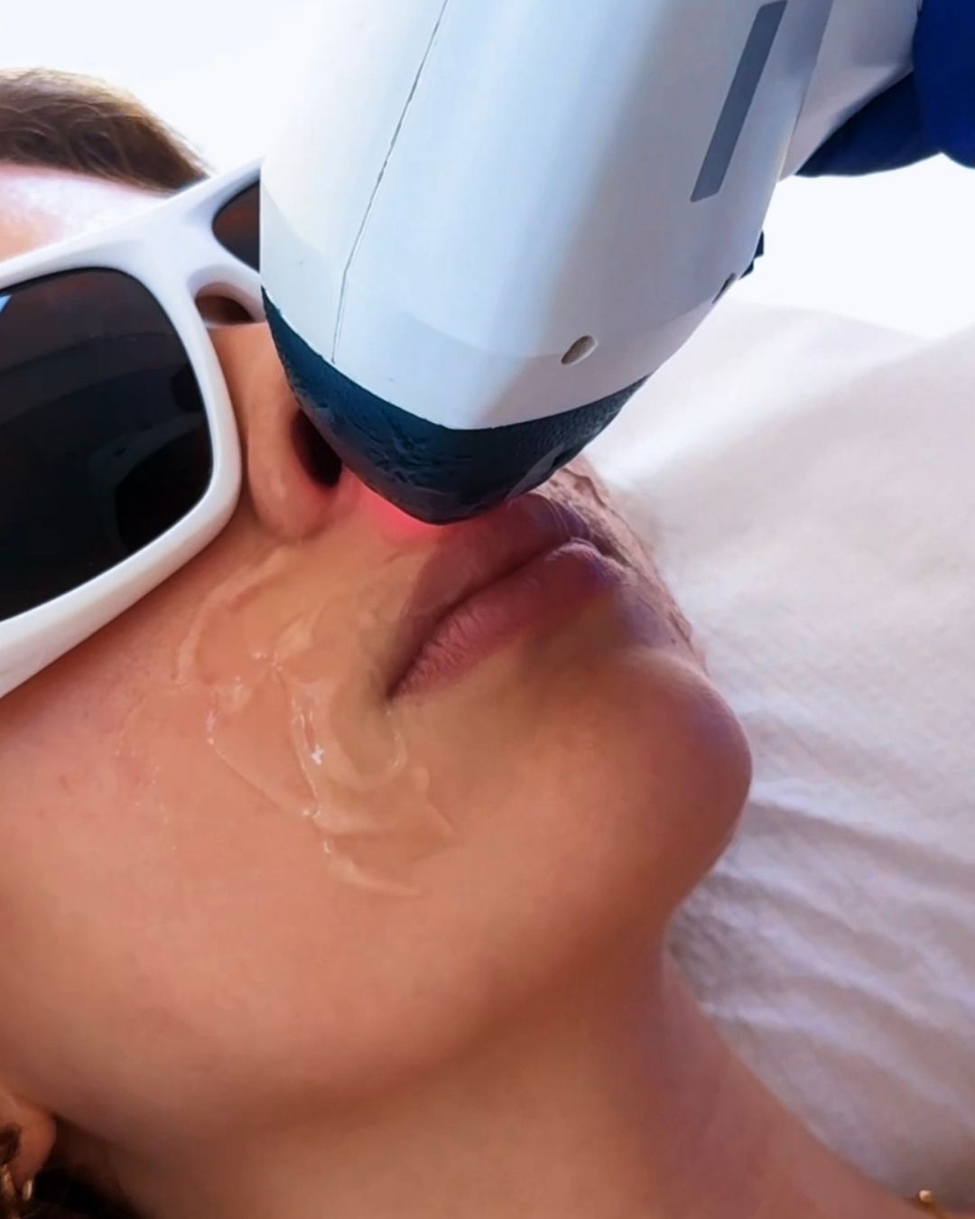 DEPILACIÓN LÁSER BOZO + AXILAS